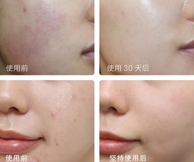 不打针就能有效去皱纹的产品,不用打针就能去皱的产品