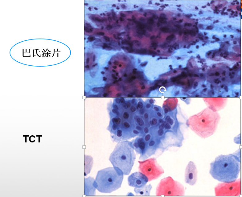 宫颈癌前病变就是宫颈癌早期么,防止宫颈癌前病变累及腺体复发