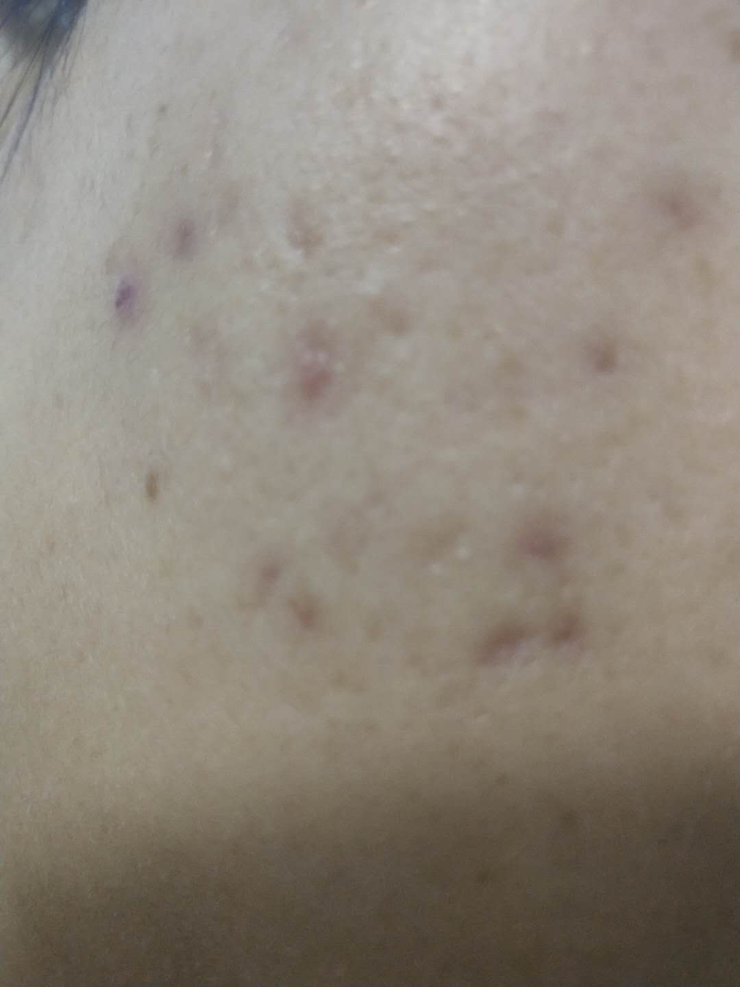 祛额头痘痘和痘印小妙招学生党,去痘痘痘印方法简便