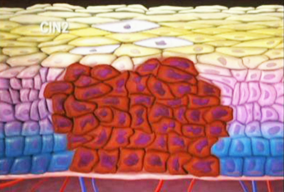 宫颈癌前病变不用怕，及时发现早治疗