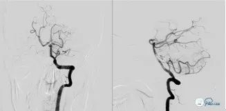 基底动脉闭合手术,基底动脉闭塞取栓一直昏睡