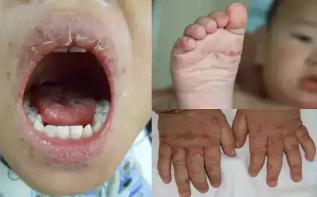 鉴别疱疹性咽峡炎和手足口病,疱疹性咽峡炎转成手足口了怎么办