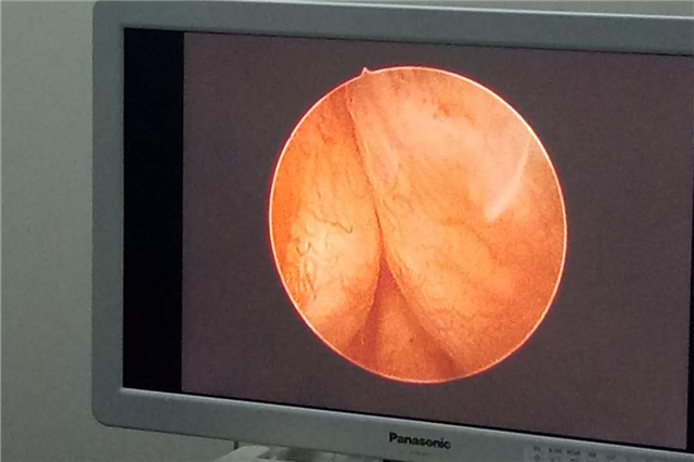 前列腺增生经尿道微创电切手术,前列腺增生加膀胱结石微创手术