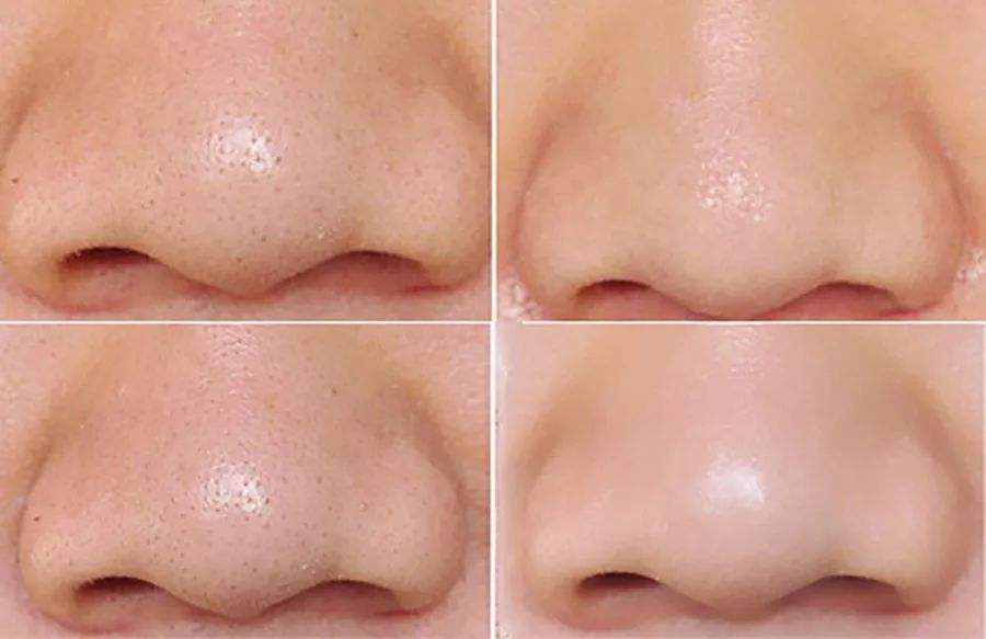 这可能是最有效的去黑头方法!只有深刻认识草莓鼻,才能搞定它!