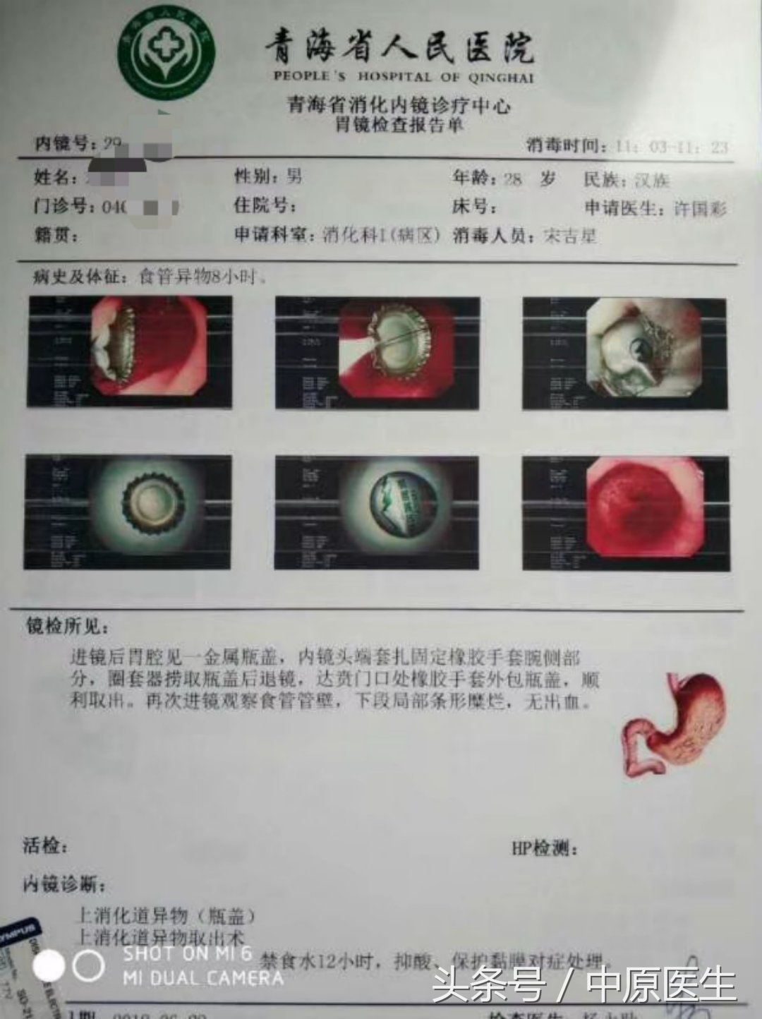 让人脑洞大开的“套套”用法：专家把男子喝到胃里的啤酒盖取出