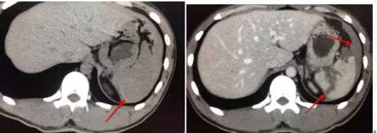 不可思议，22岁的小年轻，转呼啦圈转到脾破裂！