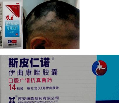 治疗真菌感染皮肤病中药外用,真菌感染皮肤药膏大全