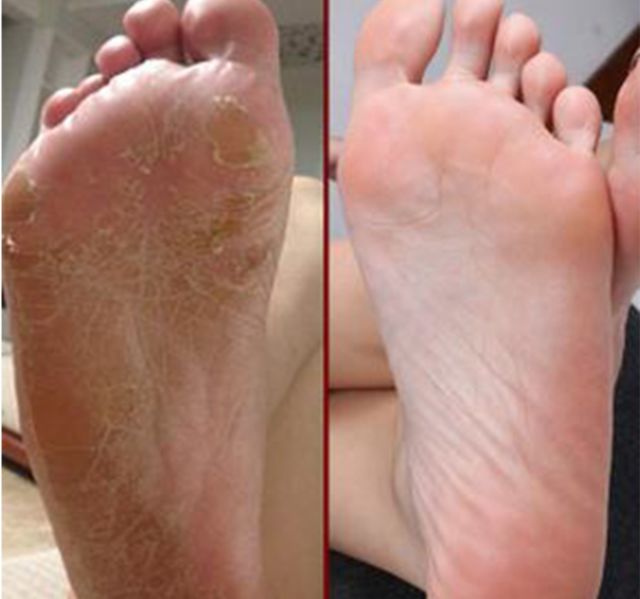 擦掉一张皮，双脚换皮术！死皮、老茧一喷就没，15秒还原嫩白玉足