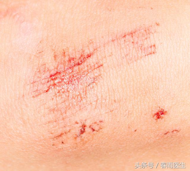 狗轻轻咬没破皮需要打狂犬疫苗吗,被狗划破痘痘要打狂犬疫苗吗