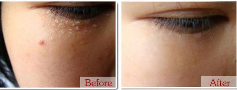 不用针挑手指扎进刺了怎么办,不用针挑就能挑出刺的方法