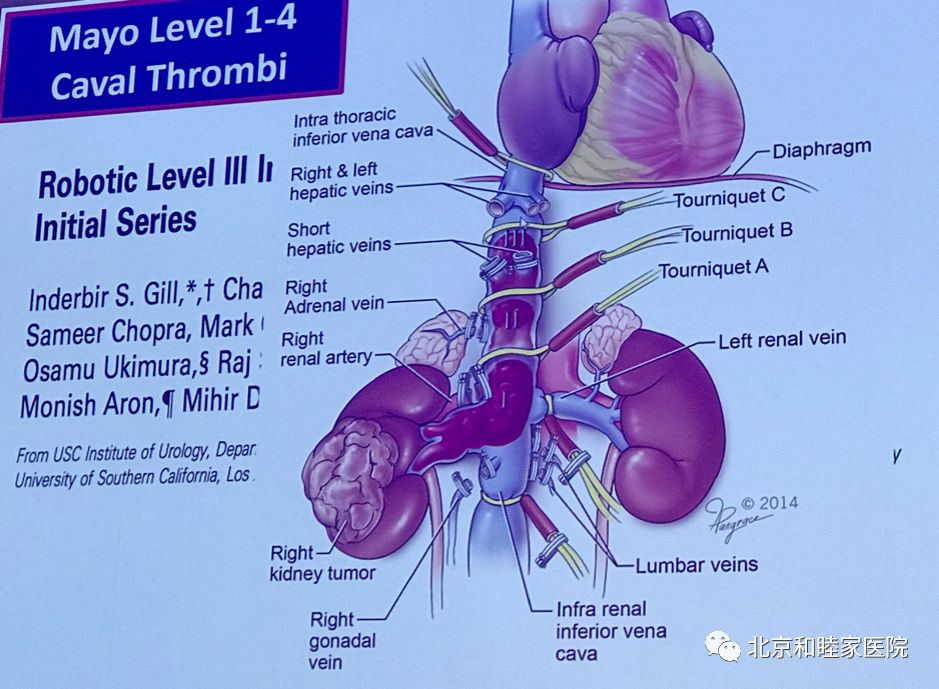 科普大赛腹腔镜手术机器人,腹腔镜及机器人手术