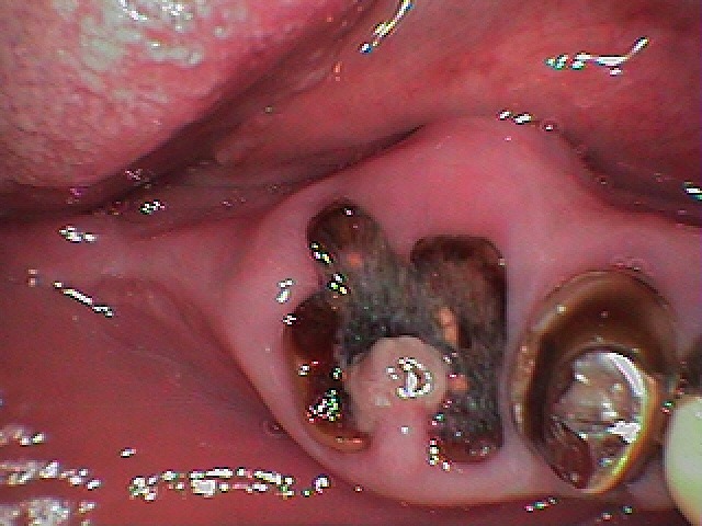 不能随便拔牙的原因,不能拔牙但是牙坏了怎么办