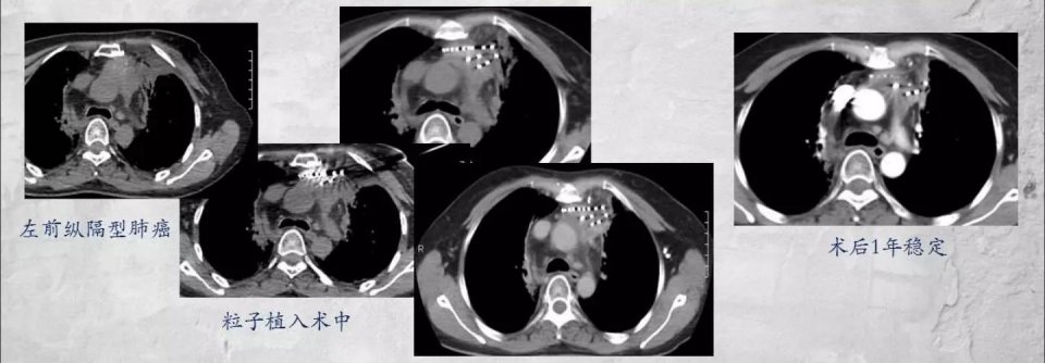癌症靶向药治疗一年费用是多少,免疫加靶向治疗癌症几次能见效