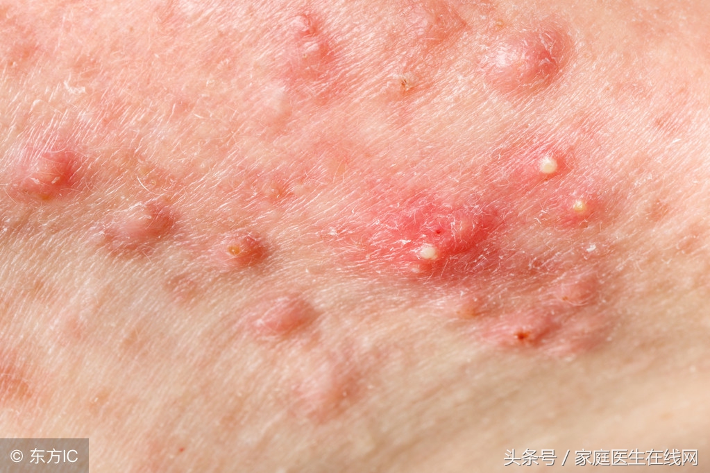 疮疡是由哪些因素引起的呢,疮疡前期的治疗方法