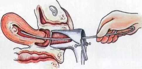 无痛人流靠谱吗会留下后遗症吗,无痛人流有报应吗