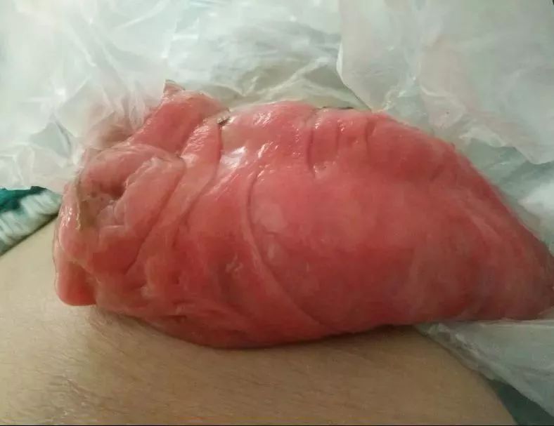 世界首位活体移植的医生,世界第一例小肠活体移植医生