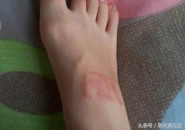 宝宝身上莫名起蚊子咬的小红疙瘩,宝宝身上有点小红点