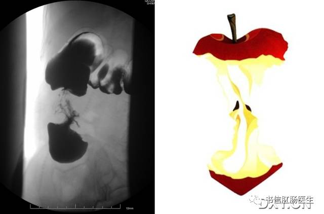 10种经典肠道影像征象：绳征、串珠征、螺纹征……你听过几个？