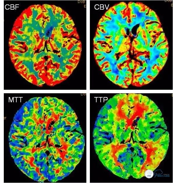 大脑中动脉支架术后再狭窄的几率,天坛医院介入脑血管手术