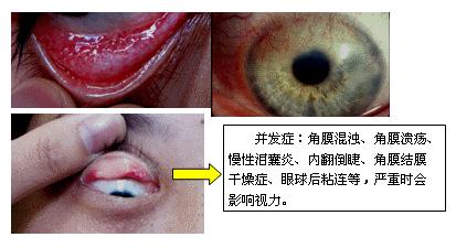 沙眼衣原体感染有什么症状和治疗,沙眼中医诊断