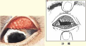 沙眼衣原体感染有什么症状和治疗,沙眼中医诊断