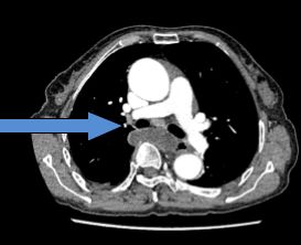 肺癌合并肺纤维化治疗,肺栓塞患者合并肺癌