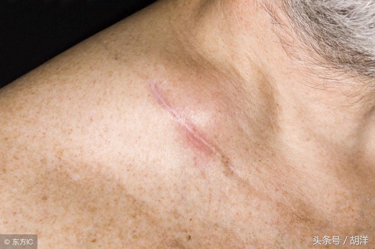 咽喉炎引起的淋巴结肿大多发性,咽喉炎引起淋巴结肿大会不会是hiv