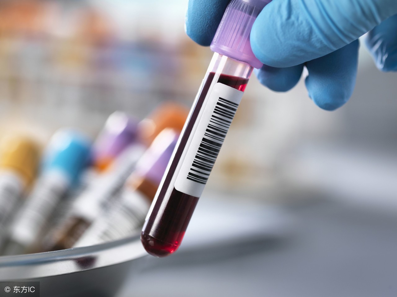 放支架后身上有淤青是怎么回事,支架手术后手掌淤青