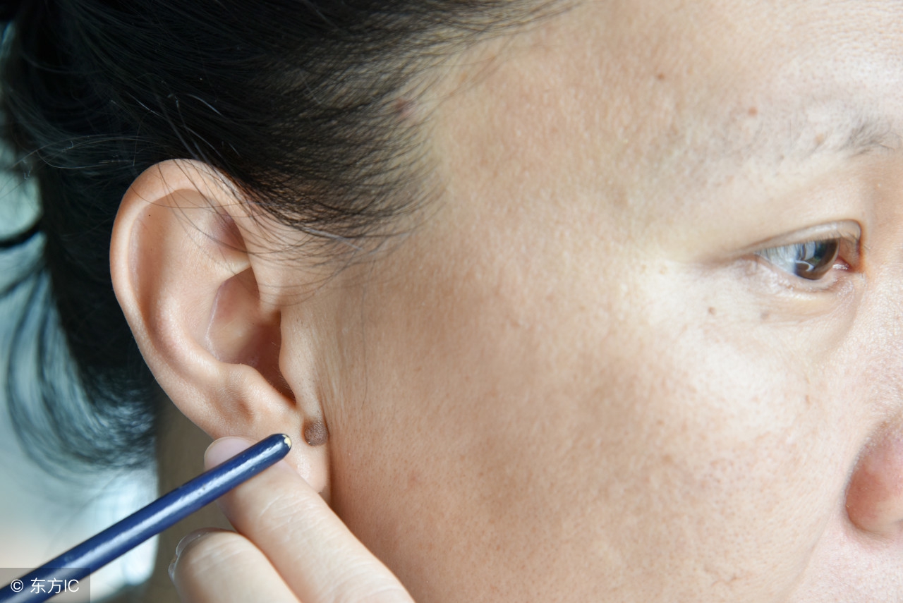 点痣的危害与副作用为什么会长痣,点痣有哪些注意事项