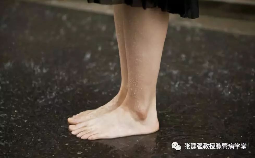 「杏林微科普」暴雨天，外出蹚水淋雨，小心得了脉管炎！