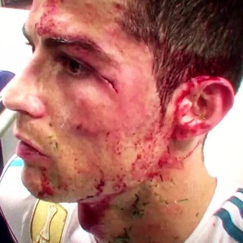 c罗被打满脸是血是哪一次,眼角被撞出血了一定要缝针么