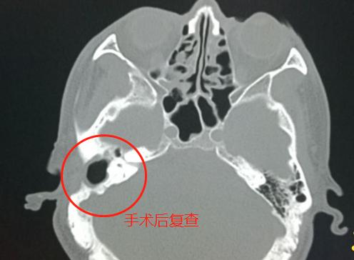 孩子急性中耳炎听力下降,中耳炎导致的听力下降可以恢复吗