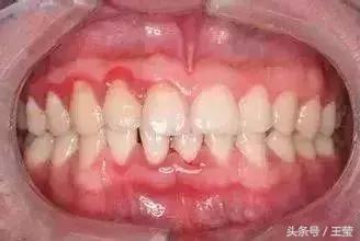 新生儿牙龈上的白脓包,牙龈炎症脓包疼痛怎么办