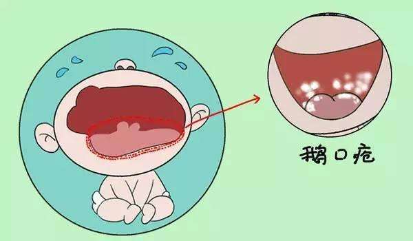 新生儿鹅口疮原因是什么,新生儿鹅口疮引起的原因是什么