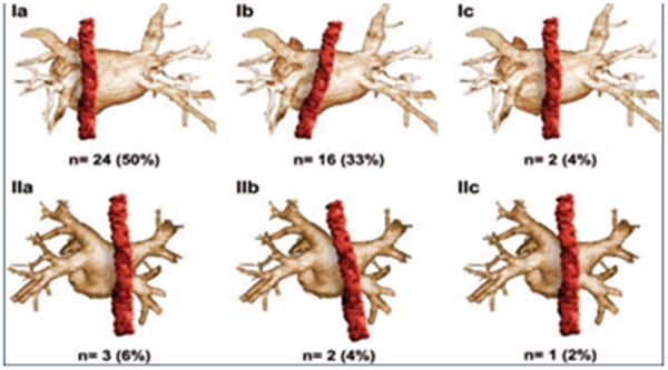 「房颤专项能力培训第3期」许静：心房食管瘘的预防、早期发现及处理
