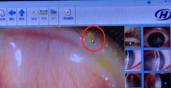 14岁女孩戴美瞳感染,14岁女孩戴美瞳可以吗