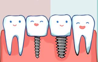 新加坡植牙介绍,新加坡植牙图片大全
