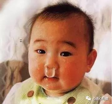 宝宝有炎症反复流鼻涕发热,宝宝着凉流鼻涕发热小妙招