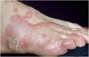 治疗足癣烂脚丫用什么药 (手癣足癣药物)