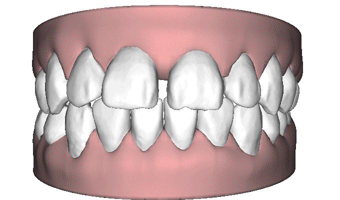 门牙牙缝大矫正最快的方法,门牙牙缝大怎么修复不伤牙齿