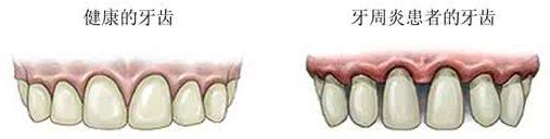 牙周刮治和洗牙有区别吗,洗牙一个月后做牙周刮治可以吗