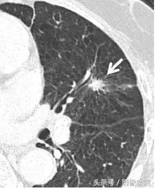 肺结节14种影像,一百例有结果的肺结节影像分析