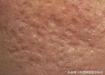 疮疤里有洞怎么修复,疮痈留下的疤能治吗