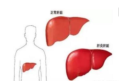 肝炎不治就会变肝癌吗,肝炎不治好会成癌吗