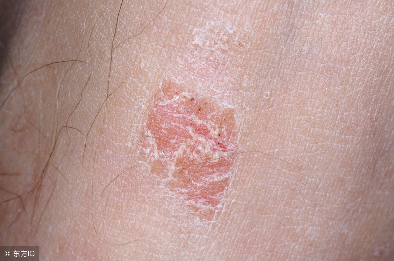 男性外阴疱疹引起的症状,男性生殖器疱疹的症状用什么药治疗