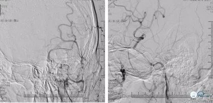 颈动脉闭塞介入治疗的风险,慢性动脉闭塞症病例