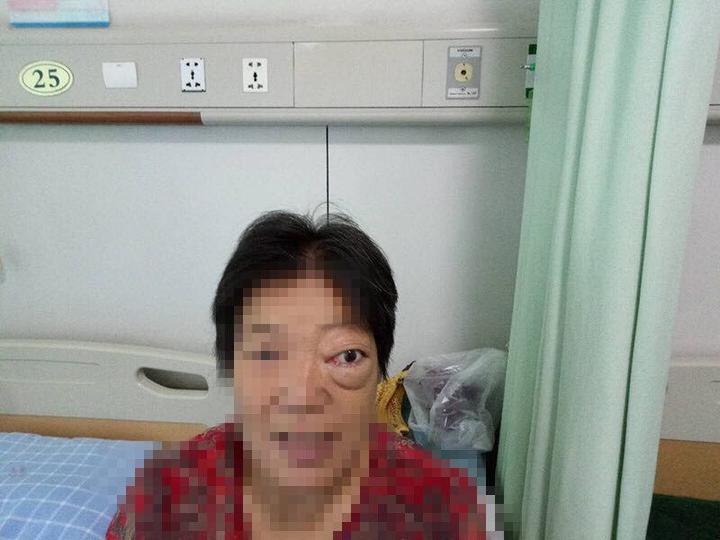 65岁老太长了“青蛙”眼，一查竟然是脑子里长了个瘤