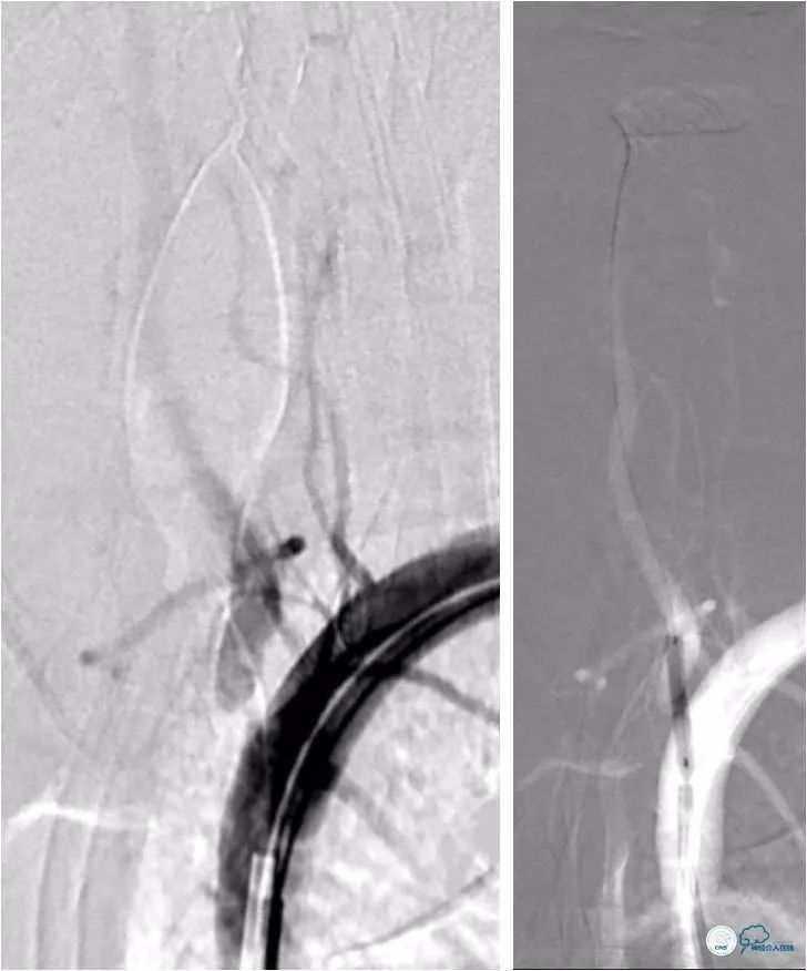 天坛周记｜左椎动脉开口及基底动脉串联狭窄血管内介入治疗1例