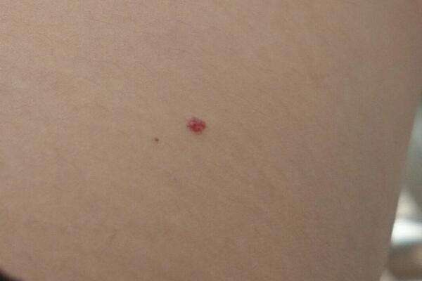 肝脏不好手上有红点能治好吗,手上青筋暴起是不是肝脏有问题