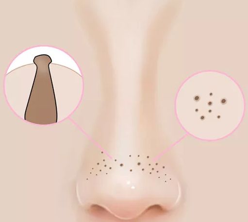 用了泥膜黑头祛不掉,黑头去不去除